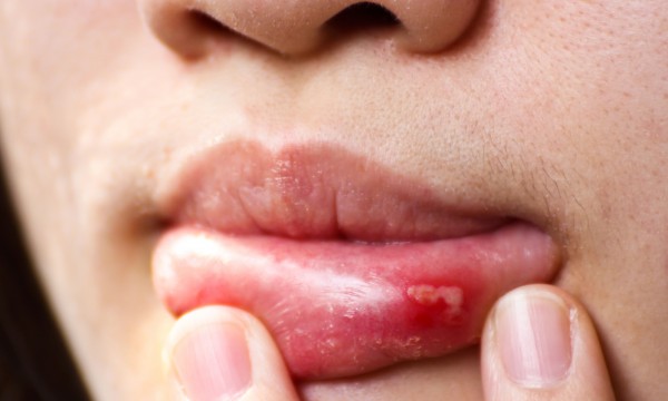 Прыщик на губе и это не герпес - какие могут быть причины и как лечить