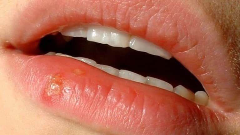 Прыщик на губе и это не герпес - какие могут быть причины и как лечить