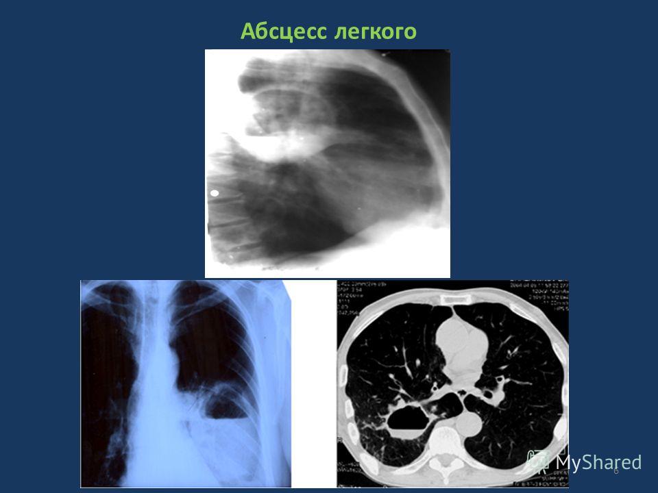Абсцесс легкого фото