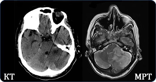 На изображении снимок МРТ (слева) и снимок КТ (справа)