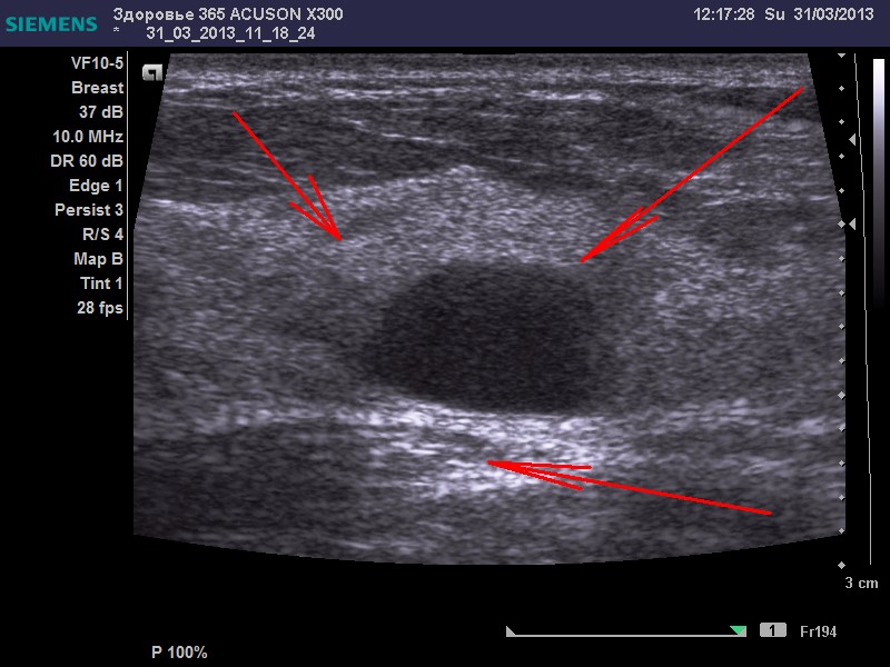 Узи молочных желез какой день цикла лучше. Карцинома на УЗИ молочных желез. Опухоль молочной железы на УЗИ. Новообразование на УЗИ В молочной железе.