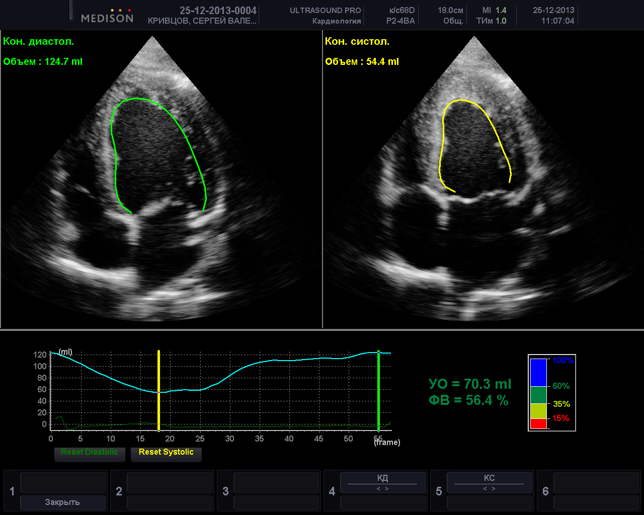 Графики при ЭХО КГ сердца