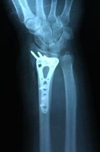 Перелом лучевой кости со смещением - операция