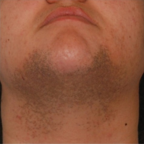 Темная кожа после бритья на лице