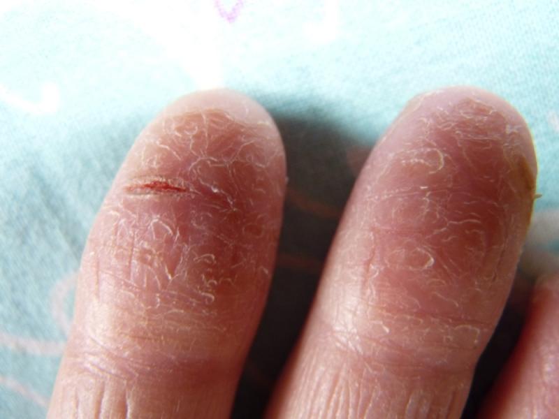 Трещины, расположенные на пальцах рук
