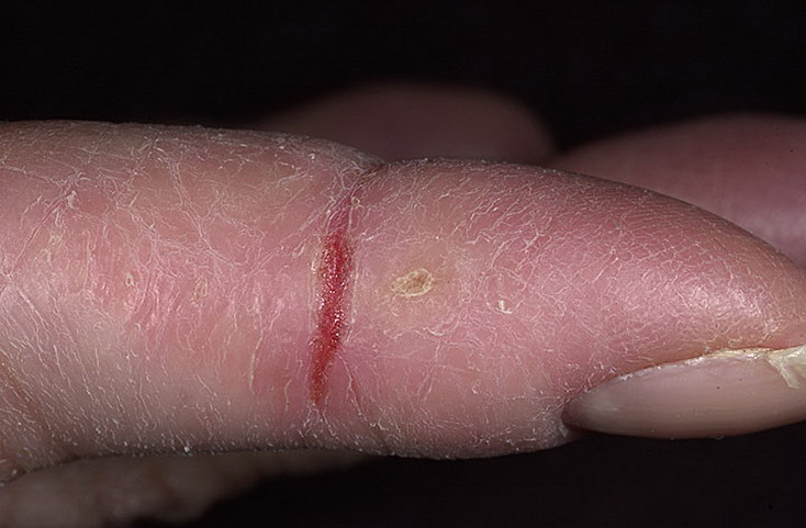 Сильный мороз – причина трещин на пальцах рук