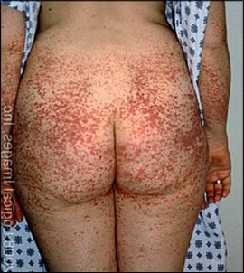 Проявления геморрагического васкулита на теле взрослой женщины