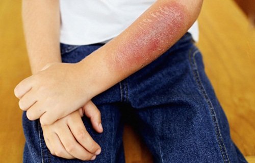 Повреждение кожи высокими температурными режимами