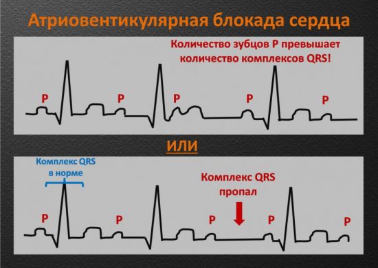 АВ-блокада сердца