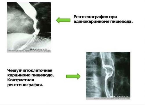 Рентген при раке пищевода