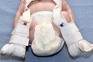 A Pavlik harness being used to secure a baby