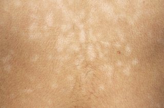 Dark skin with smaller lighter patches caused by pityriasis versicolor.