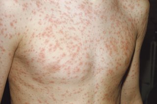 A rash of hundreds of small pink spots covering the chest of a child with pale skin