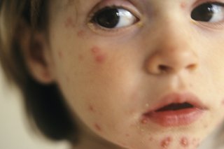 Chickenpox