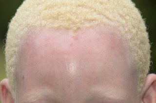 An African girl with albinism. She has pale skin and short, light blonde hair.