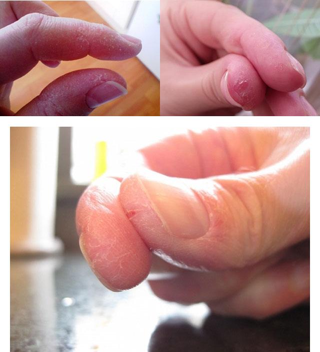 Трещины на пальцах рук 