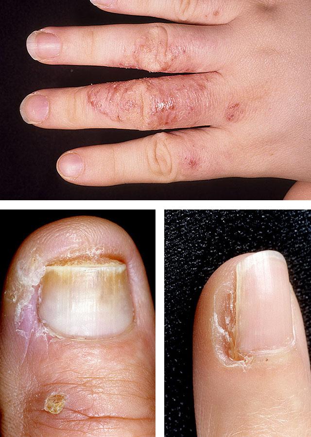 Трещины возле ногтей