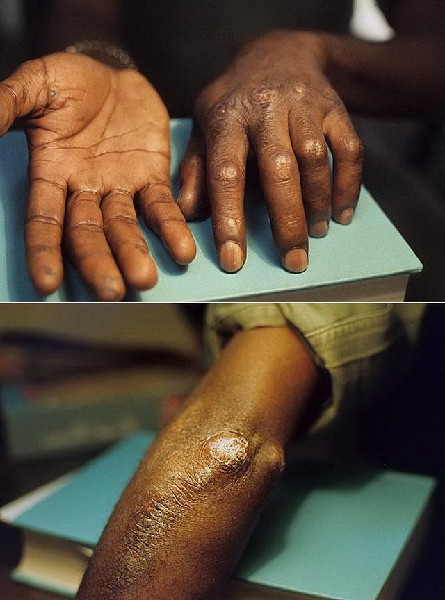 Кальциноз кожи рук