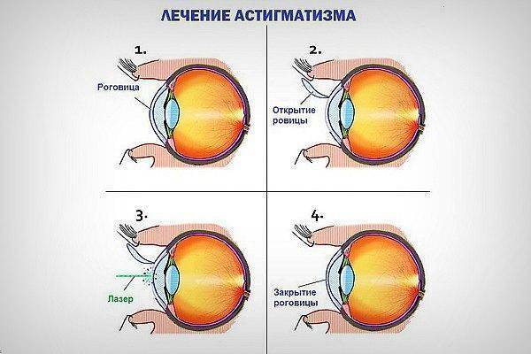 Астигматизм гиперметропический у детей что это такое