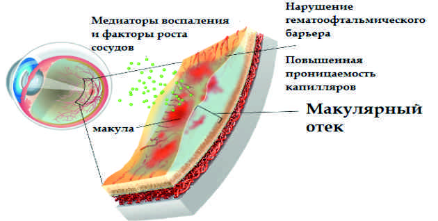 Аллергия опухли глаза что делать