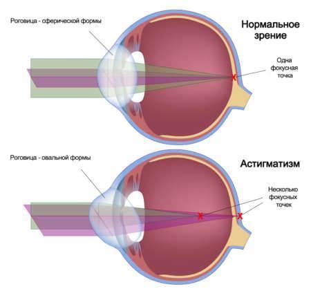 Астигматизм сложный гиперметропический