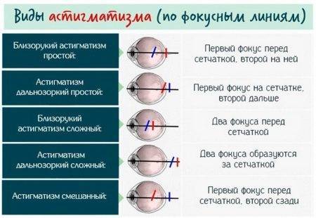 Астигматизм гиперметропический у детей что это такое