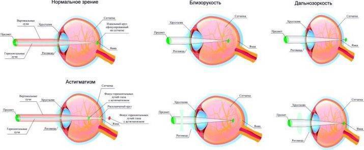 Астигматизм гиперметропический у детей что это такое