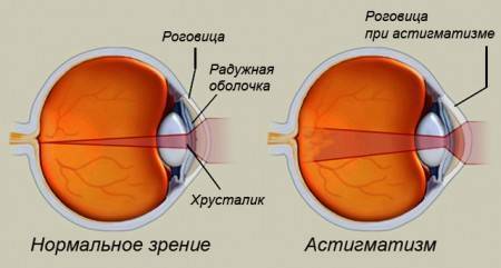 Астигматизм гиперметропический у детей что это такое