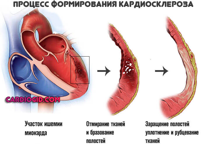 формирование-кардиосклероза