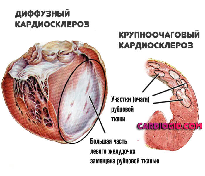 кардиосклероз-диффузный