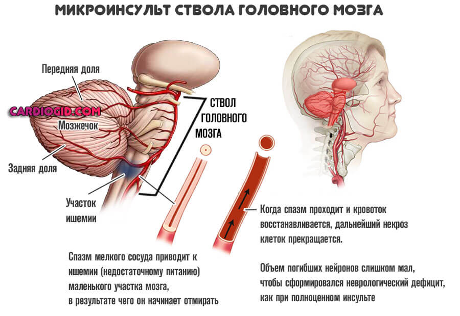 микроинсульт-головного-мозга