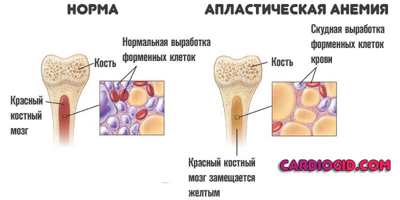 апластическая анемия