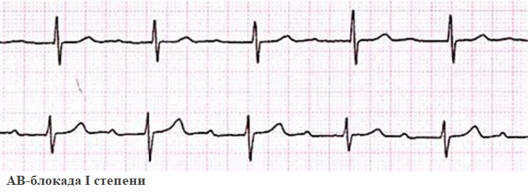 АВ-блокада I степени