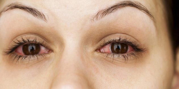Почему чешутся глаза: конъюнктивит
