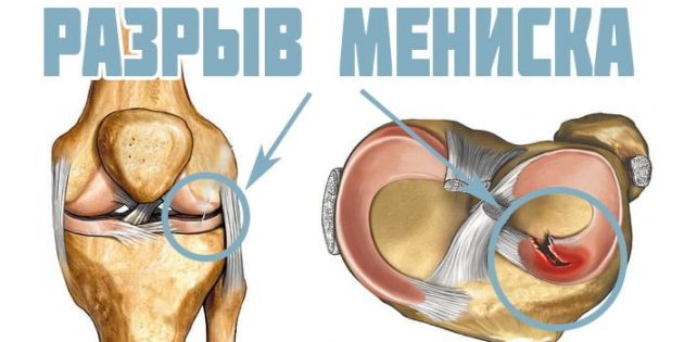 Почему болят колени: травма мениска