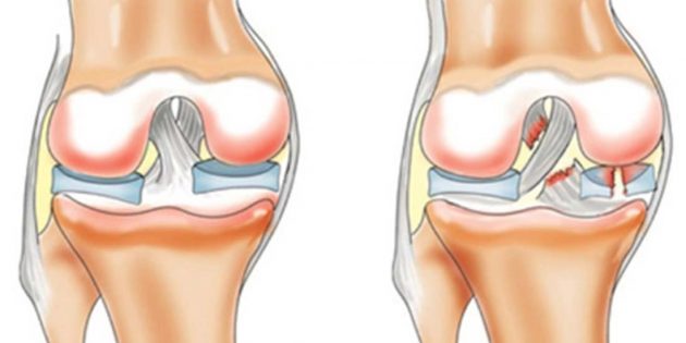 Почему болят колени: разрыв передней крестообразной связки