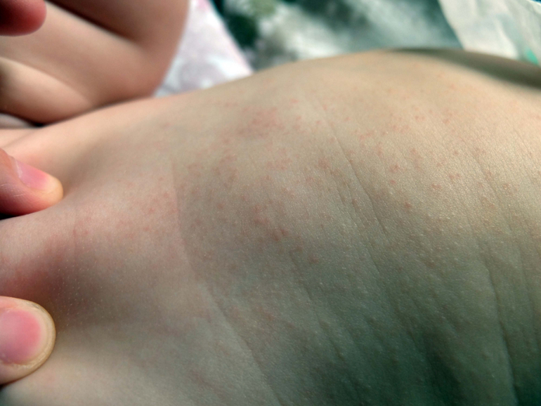 Сыпь на ступнях и ладошках у взрослого Ладонно