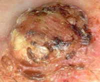 Photograph of squamous cell cancer