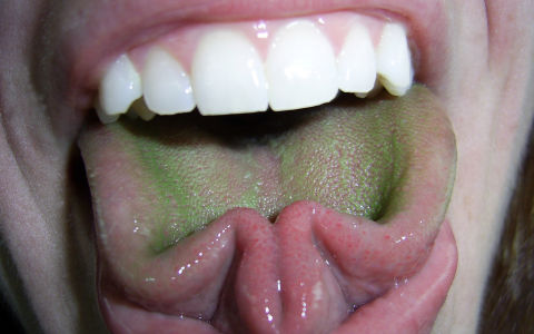 Зеленый налет на языке: причины появления и лечение