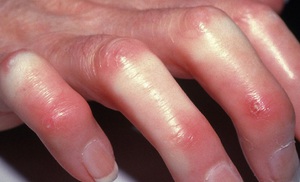 Склеродермия - полисиндромное заболевание, проявляющееся прогрессирующим фиброзом кожи