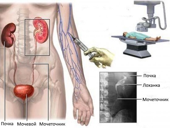Исследование почек и мочевыводящих путей с применением рентгенконтрастного вещества