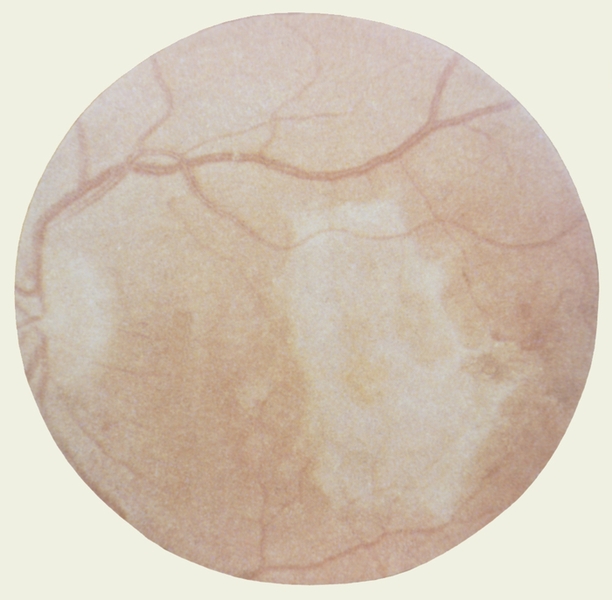 Рис. 2. Офтальмоскопическая картина при центральном хориоретините, развившемся после сепсиса: атрофический хориоретинальный очаг белого цвета с четкими контурами