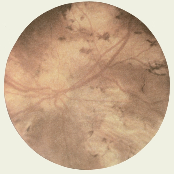 Рис. 3. Офтальмоскопическая картина при диссеминированном туберкулезном хориоретините: видны множественные хориоретинальные очаги с темными отложениями пигмента