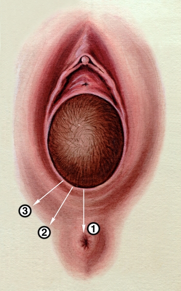 Схематическое изображение разрезов промежности при прорезывании головки плода: 1 — перинеотомия; 2 — срединно-латеральная <a href=