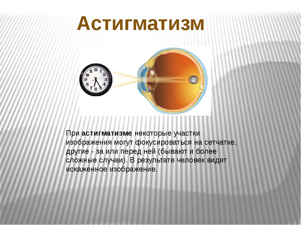 Степени астигматизма. Катаракта презентация. Астигматизм физика. Астигматизм презентация. Дефекты зрения астигматизм.