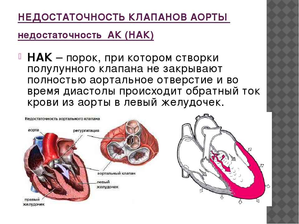 Аортальная регургитация сердца