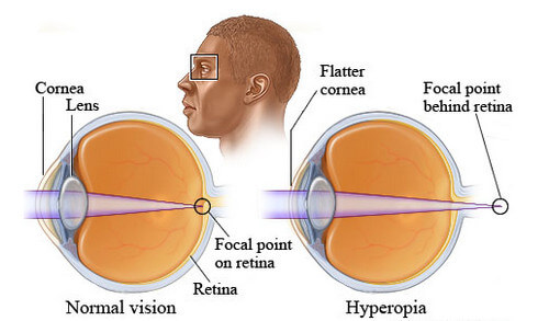 Normal vision vs Hyperopia