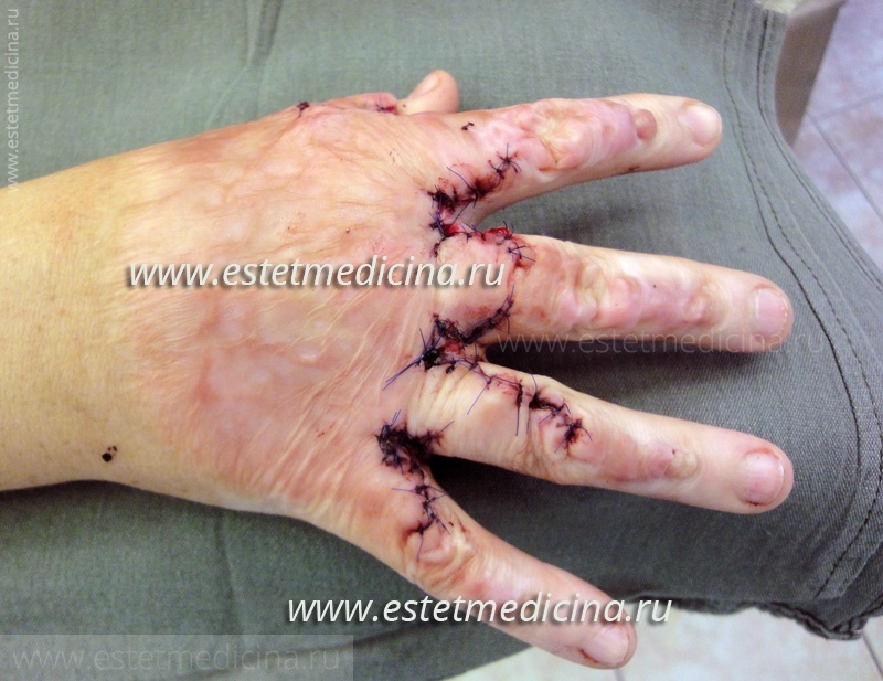 Пластика рук после ожога, лечение рубцов