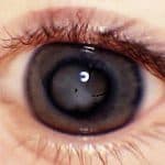 Признаки отслоения сетчатки глаза что это такое, симптомы, лечение народными средствами, послеоперационный период, последствия