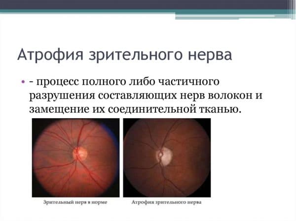 стадии атрофии зрительного нерва